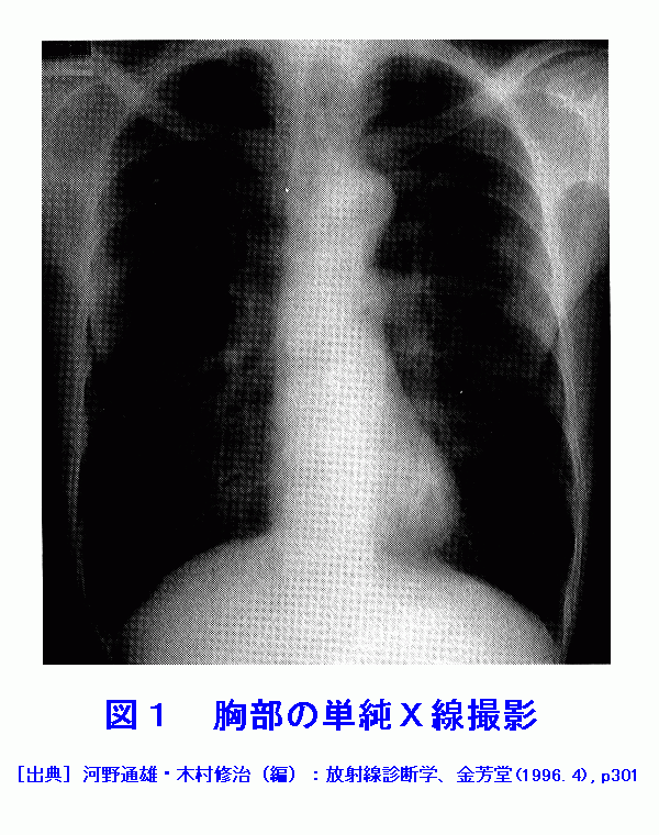 図１  胸部の単純Ｘ線撮影