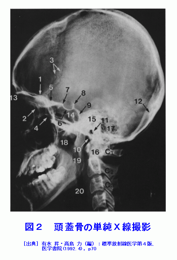 図２  頭蓋骨の単純Ｘ線撮影