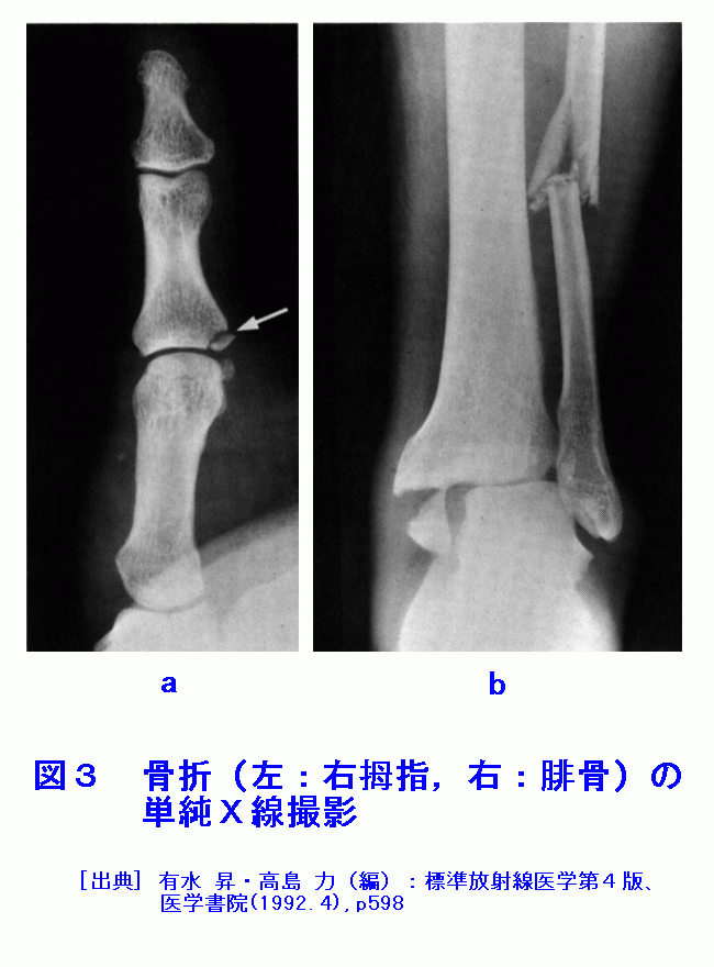 図３  骨折（左：右拇指、右：腓骨）の単純Ｘ線撮影