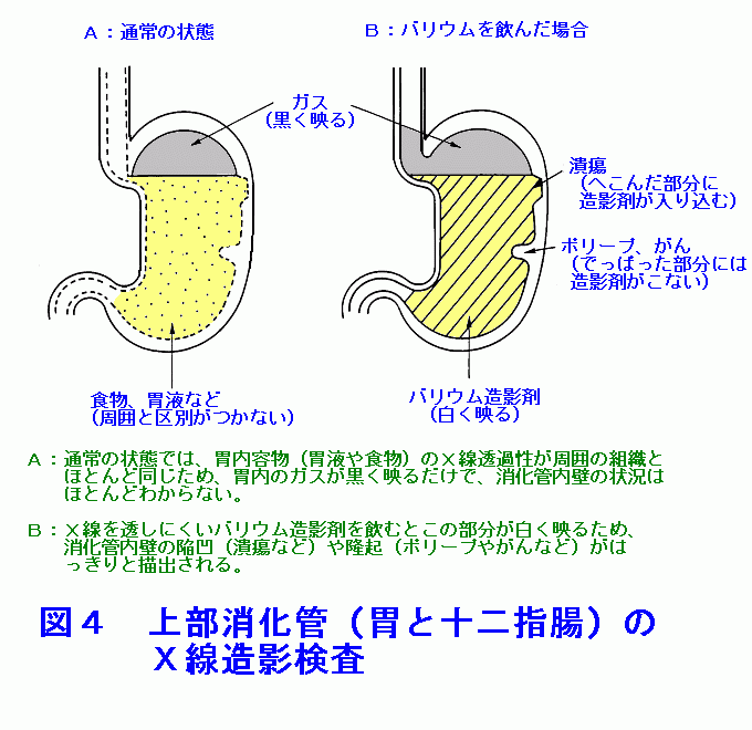 図４  上部消化管（胃と十二指腸）のＸ線造影検査