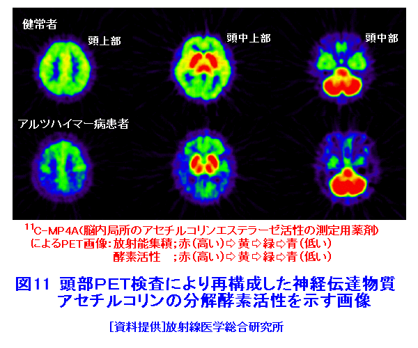 図１１  頭部PET検査により再構成した神経伝達物質アセチルコリンの分解酵素活性を示す画像