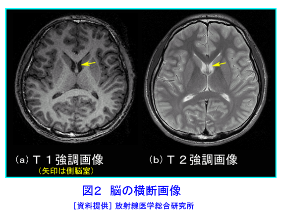 図２  脳の横断画像