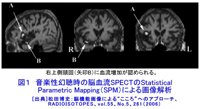 図１  音楽性幻聴時の脳血流SPECTのStatistical Parametric Mapping（SPM）による画像解析