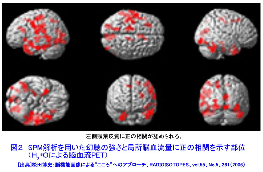 SPM解析を用いた幻聴の強さと局所脳血流量に正の相関を示す部位（Ｈ<small>2</small> <sup><small>15</small></sup>Ｏによる脳血流PET）
