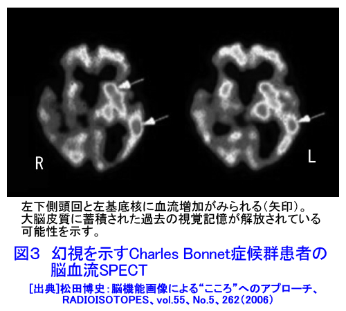 図３  幻視を示すCharles Bonnet症候群患者の脳血流SPECT