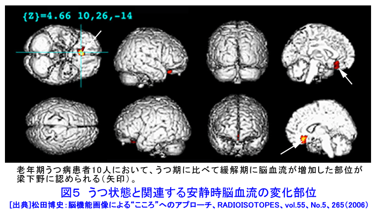 図５  うつ状態と関連する安静時脳血流の変化部位