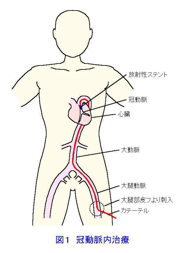 図１  冠動脈内治療