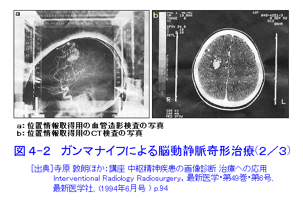 図４-２  ガンマナイフによる脳動静脈奇形治療（2/3）