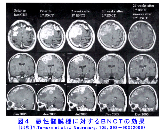 図４  悪性髄膜種に対するBNCTの効果