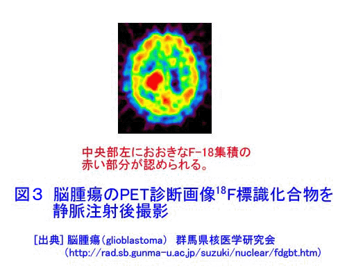 脳腫瘍のPET診断画像<sup><small>18</small></sup>Ｆ標識化合物を静脈注射後撮影