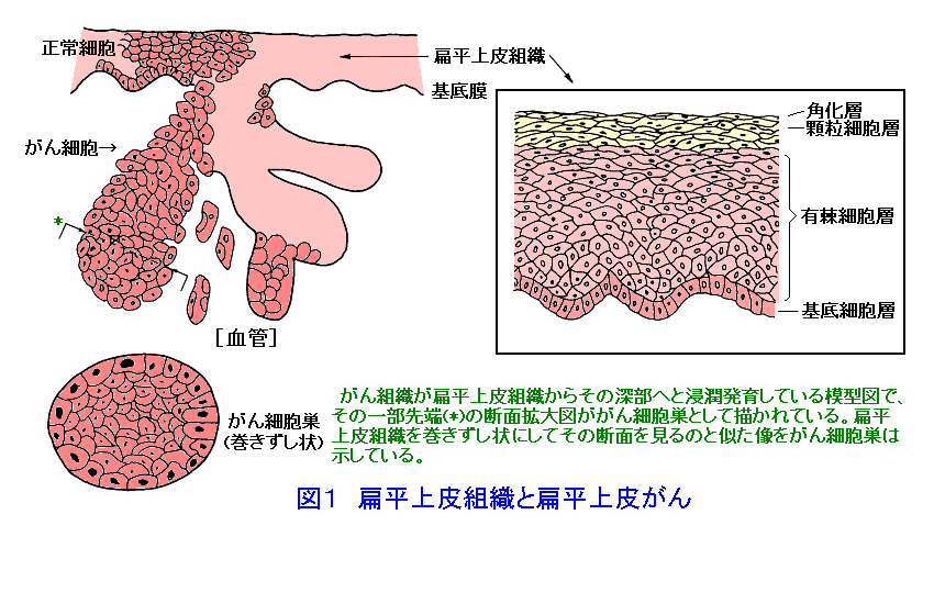図１  扁平上皮組織と扁平上皮癌