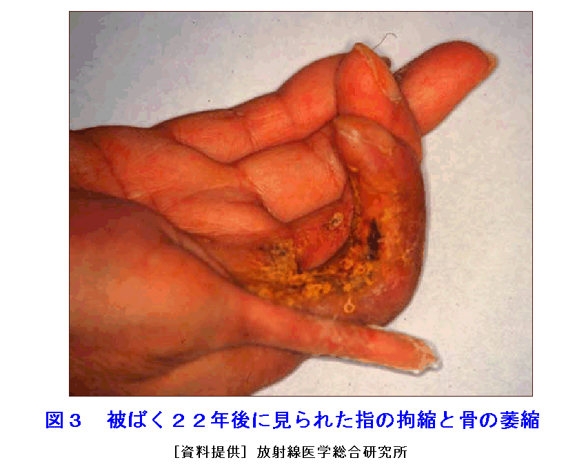 図３  被ばく22年後に見られた指の拘縮と骨の萎縮