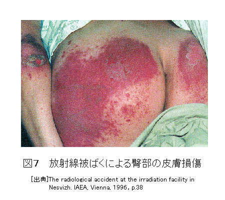 図７  放射線被ばくによる臀部の皮膚損傷
