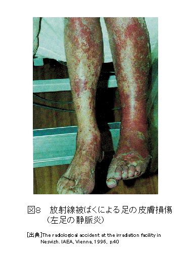 図８  放射線被ばくによる足の皮膚損傷（左足の静脈炎）